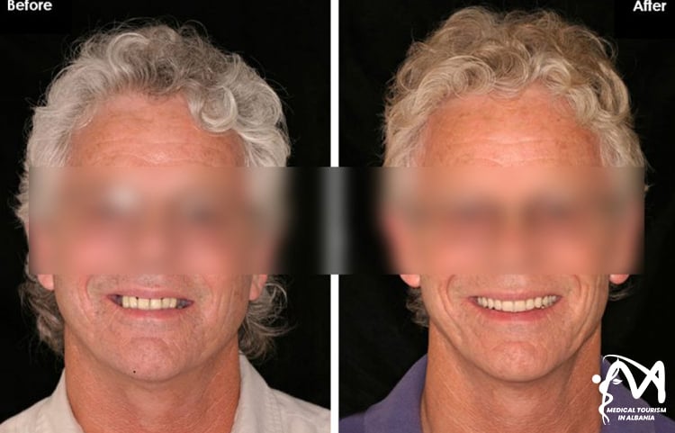 Dental-implants-before-and-after-in-Albania