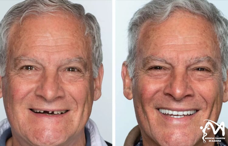 How-smile-looks-after-dental-implants