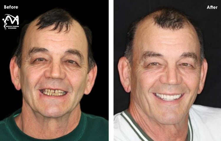 Patient-from-France-who-did-teeth-implants-in-Albania-showing-his-amazing-progress-after-3-months