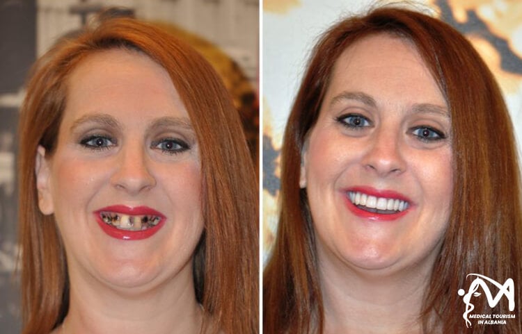 Permanent-smile-fix-and-teeth-replacement-transformation-from-a-female-patient-in-Albania-with-Medical-Tourism-Packages